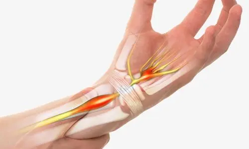 karpal_tunel_sendromu nedenleri ve tedavisi