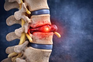 bel fıtığı ameliyatı gerekli mi